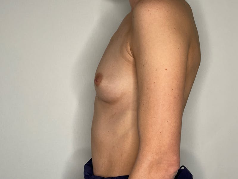 Breast Augmentation Before & After Gallery - Patient 101412261 - Image 3
