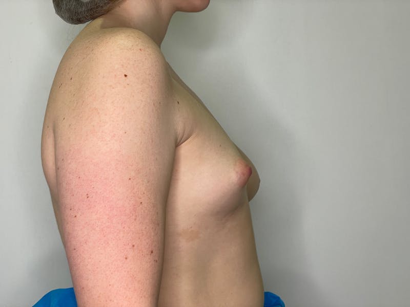 Breast Augmentation Before & After Gallery - Patient 101412264 - Image 1