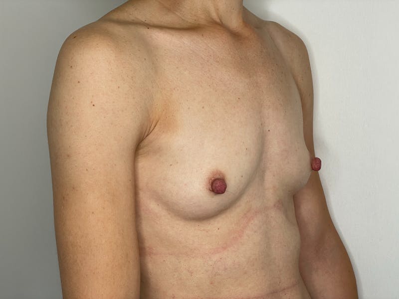 Breast Augmentation Before & After Gallery - Patient 101412317 - Image 1