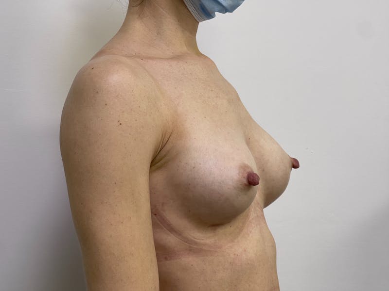 Breast Augmentation Before & After Gallery - Patient 101412317 - Image 2