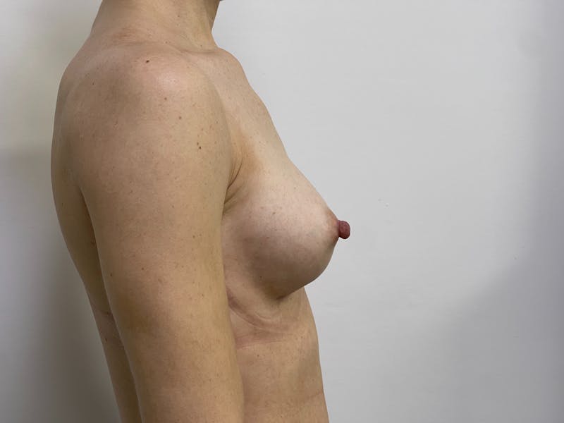 Breast Augmentation Before & After Gallery - Patient 101412317 - Image 4