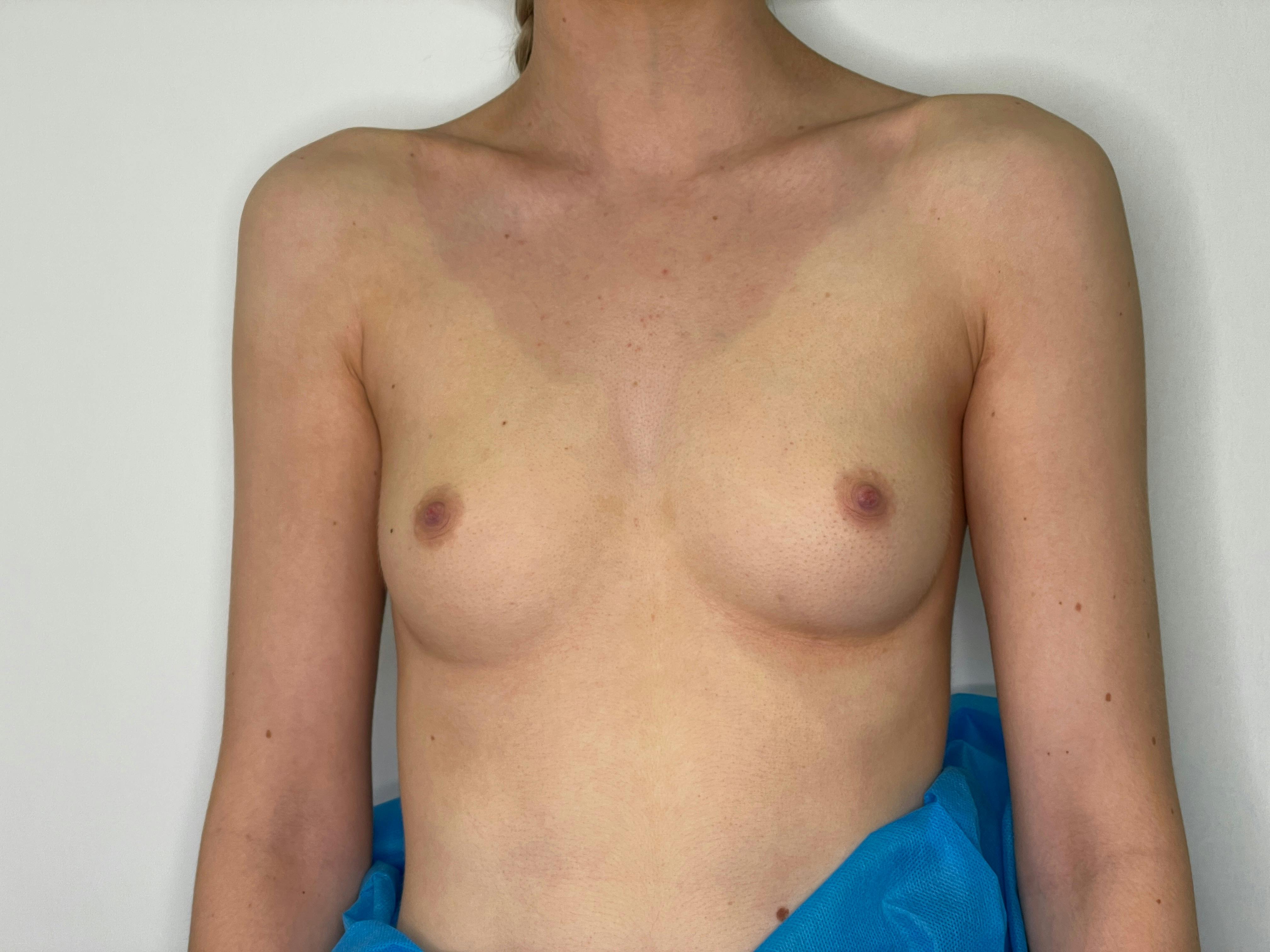 Before and after breast augmentation in Glasgow 1