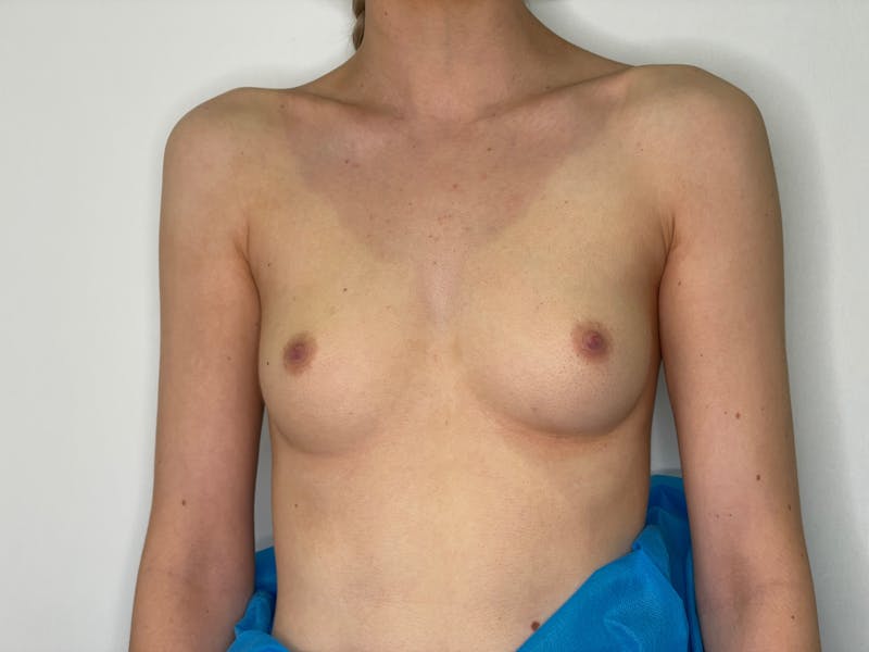 Breast Augmentation Before & After Gallery - Patient 101412318 - Image 1