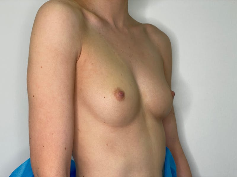 Breast Augmentation Before & After Gallery - Patient 101412318 - Image 5