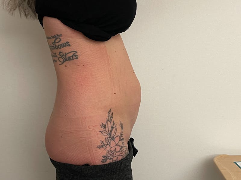 Vaser/Smart Liposuction Before & After Gallery - Patient 101412514 - Image 1