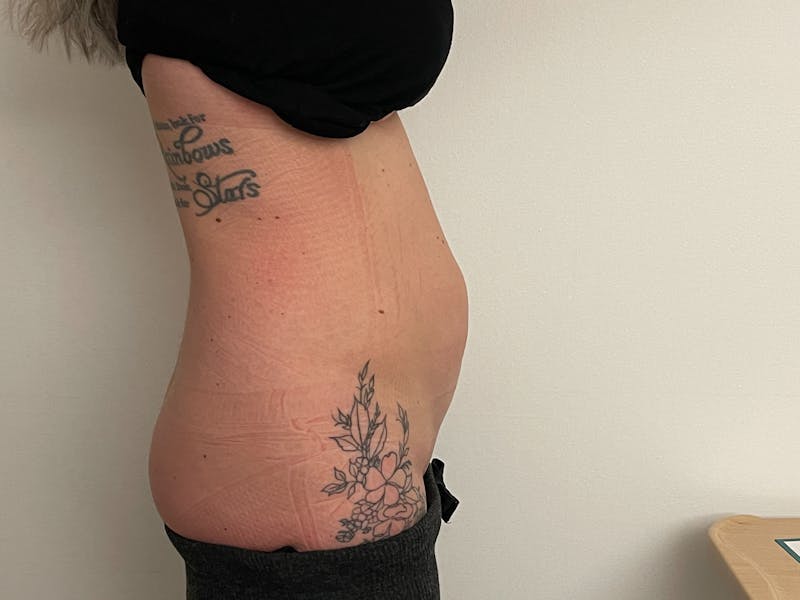 Tummy Tuck Before & After Gallery - Patient 101412497 - Image 1