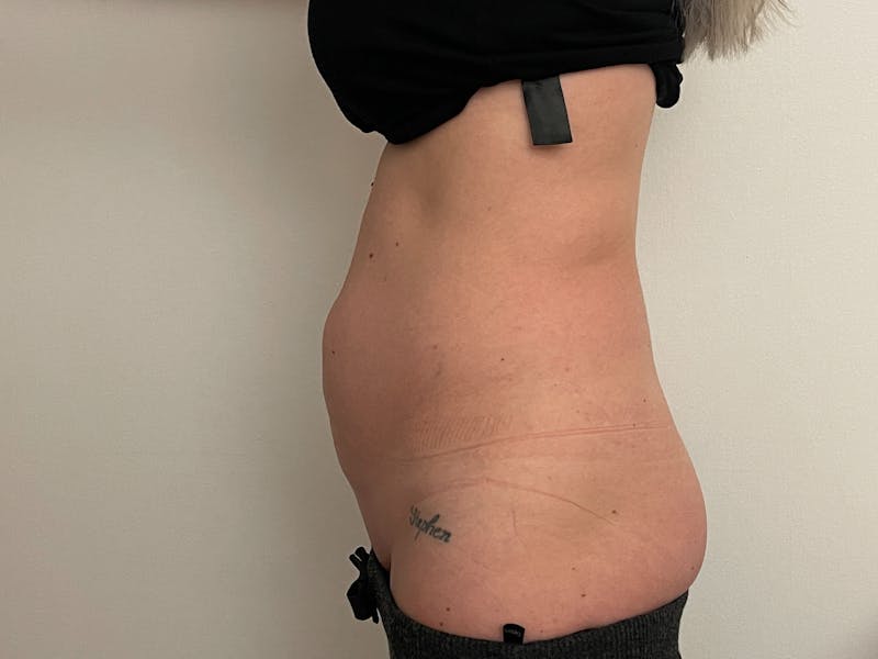 Vaser/Smart Liposuction Before & After Gallery - Patient 101412514 - Image 3