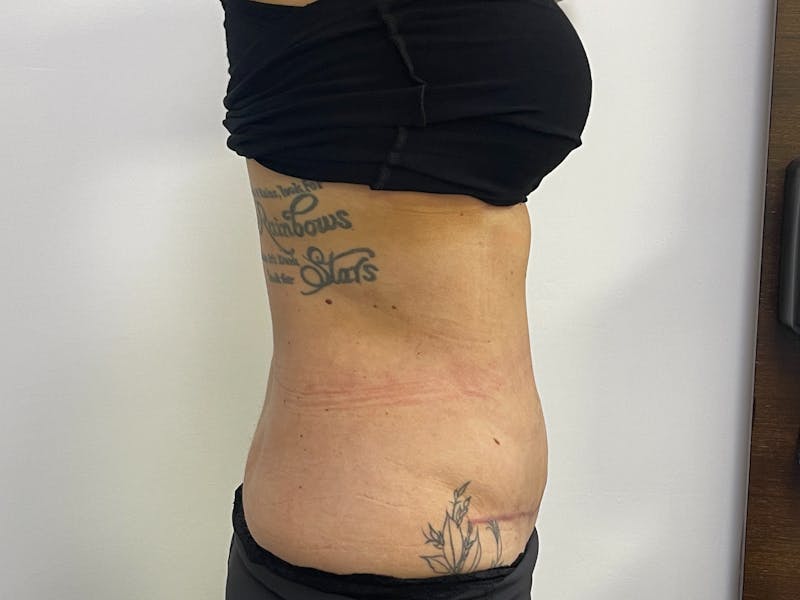 Tummy Tuck Before & After Gallery - Patient 101412497 - Image 2