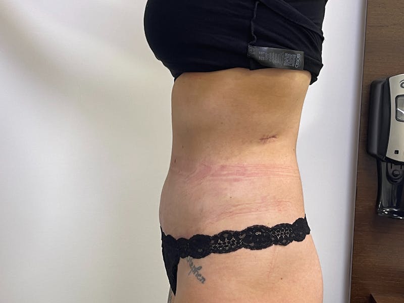 Vaser/Smart Liposuction Before & After Gallery - Patient 101412514 - Image 4