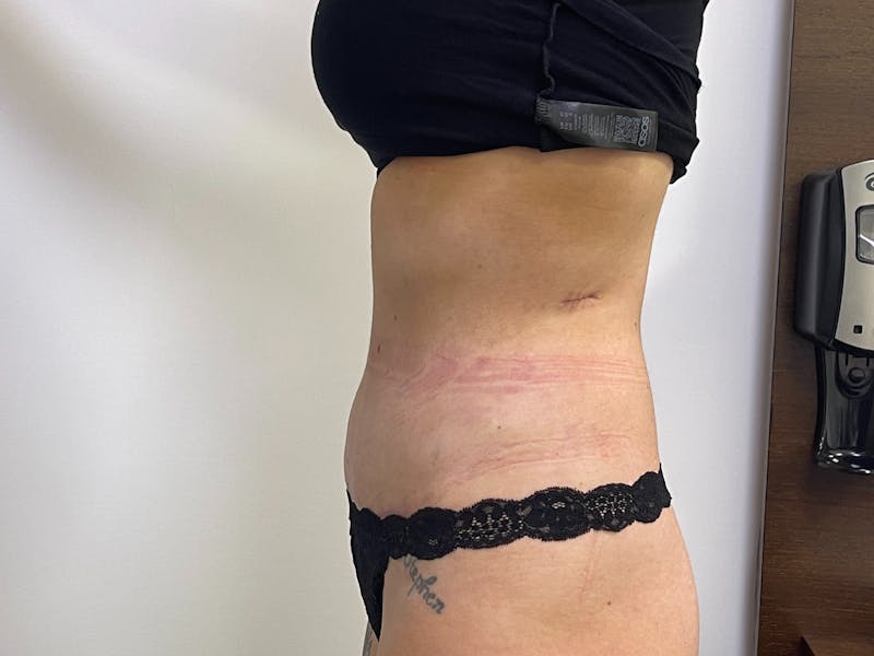 Tummy Tuck Before & After Gallery - Patient 101412497 - Image 4