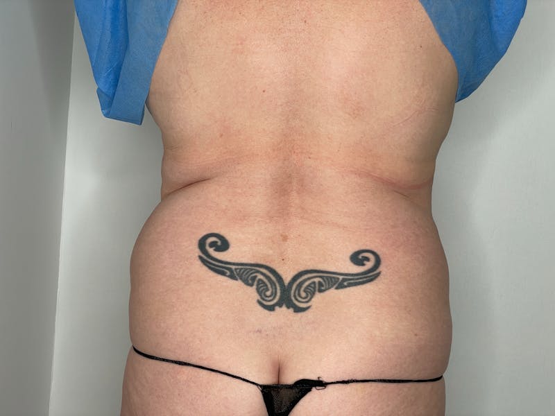 Vaser/Smart Liposuction Before & After Gallery - Patient 101412747 - Image 3