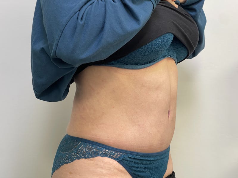 Tummy Tuck Before & After Gallery - Patient 101412529 - Image 2
