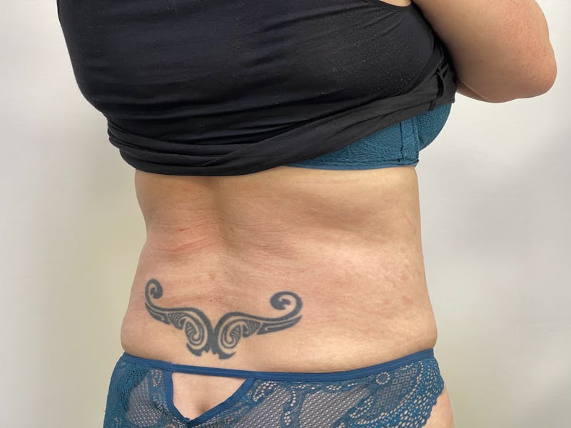 Vaser/Smart Liposuction Before & After Gallery - Patient 101412532 - Image 4