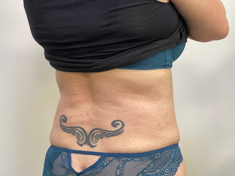 Tummy Tuck Before & After Gallery - Patient 101412529 - Image 4