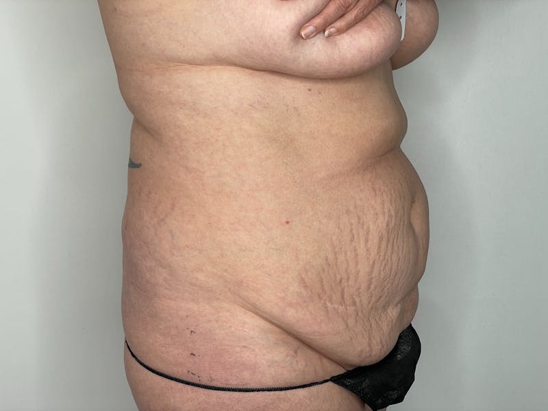 Vaser/Smart Liposuction Before & After Gallery - Patient 101412555 - Image 1