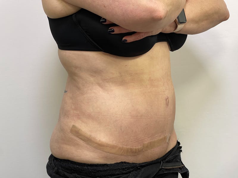 Tummy Tuck Before & After Gallery - Patient 101412548 - Image 2
