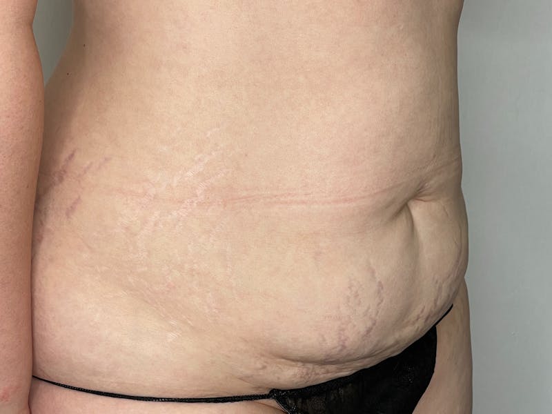 Tummy Tuck Before & After Gallery - Patient 101412551 - Image 1