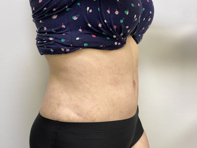 Tummy Tuck Before & After Gallery - Patient 101412551 - Image 2