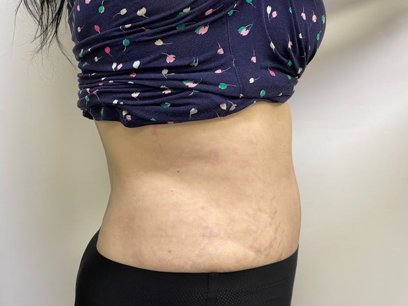 Tummy Tuck Before & After Gallery - Patient 101412551 - Image 4