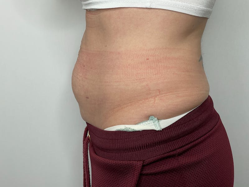 Liposuction Before & After Gallery - Patient 101412593 - Image 1