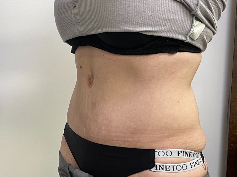 Tummy Tuck Before & After Gallery - Patient 101412550 - Image 2