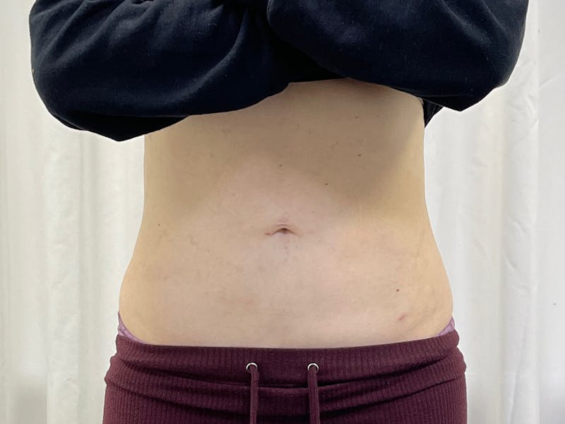 Vaser/Smart Liposuction Before & After Gallery - Patient 101412648 - Image 2