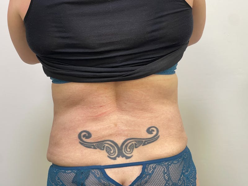 Tummy Tuck Before & After Gallery - Patient 101412741 - Image 4