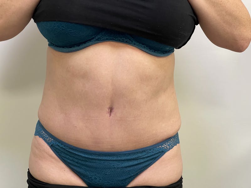 Tummy Tuck Before & After Gallery - Patient 101412741 - Image 2