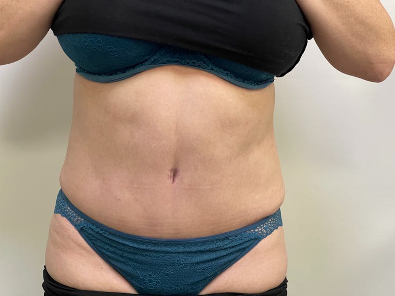 Vaser/Smart Liposuction Before & After Gallery - Patient 101412747 - Image 2