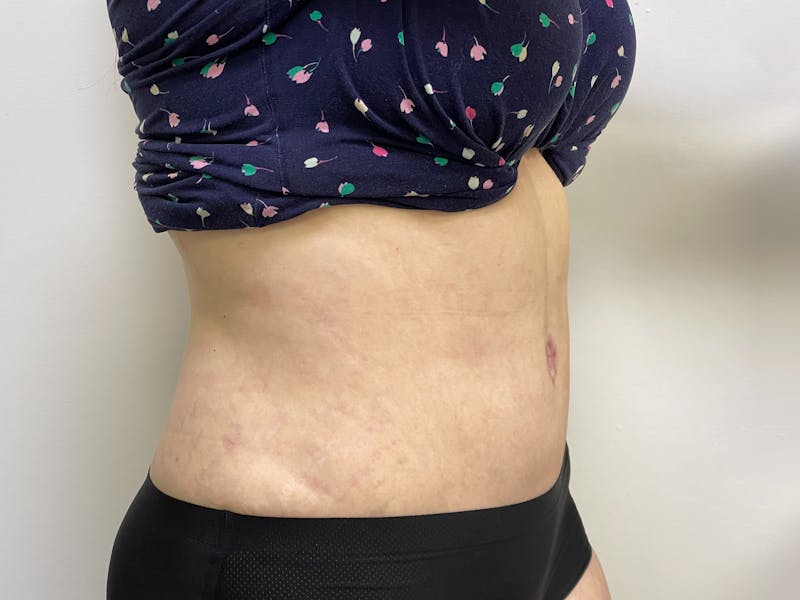 Liposuction Before & After Gallery - Patient 101412971 - Image 1
