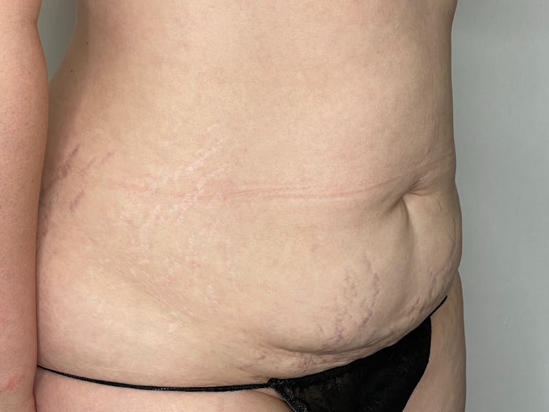 Liposuction Before & After Gallery - Patient 101412971 - Image 2