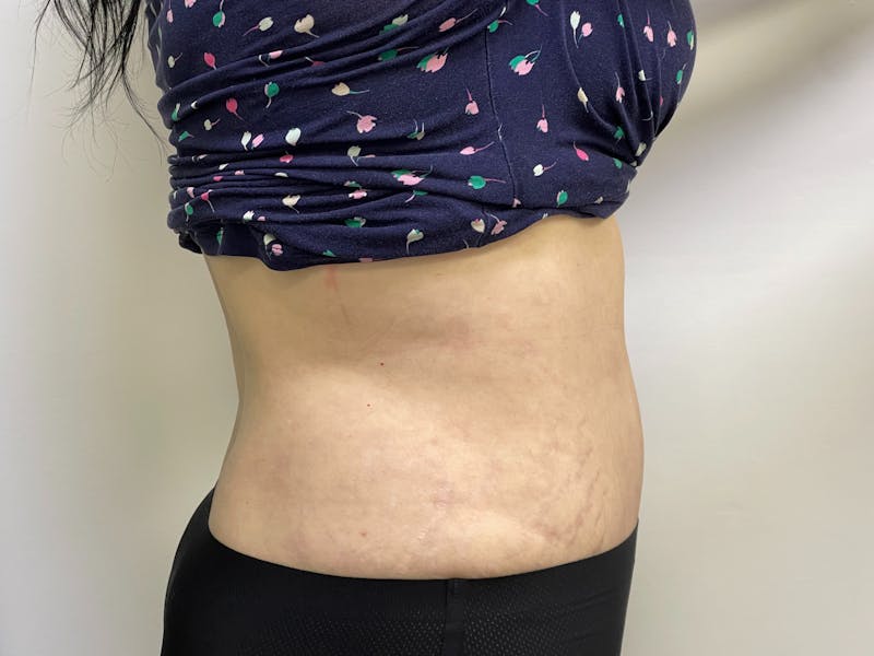 Tummy Tuck Before & After Gallery - Patient 101412969 - Image 4