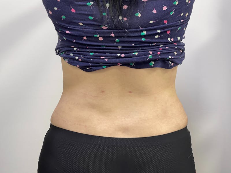 Liposuction Before & After Gallery - Patient 101412971 - Image 5