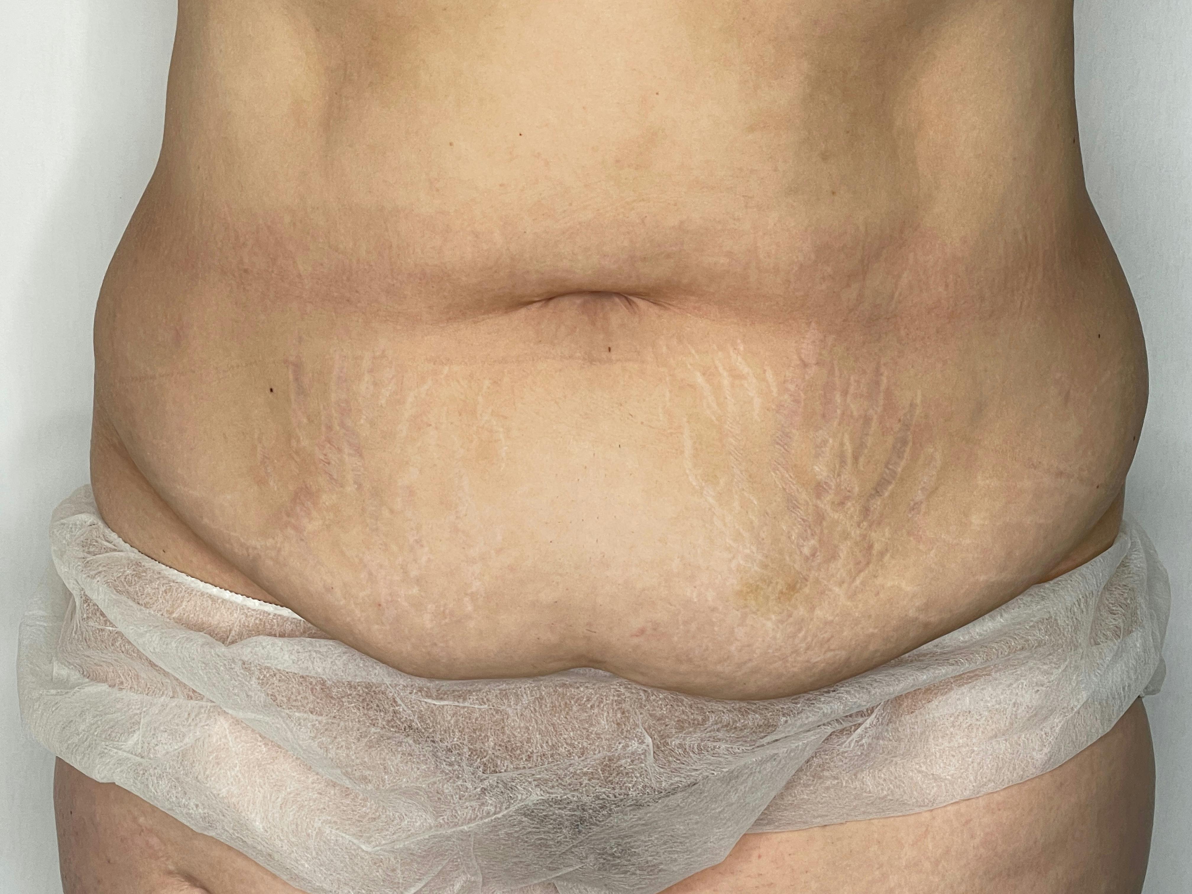 Tummy Tuck