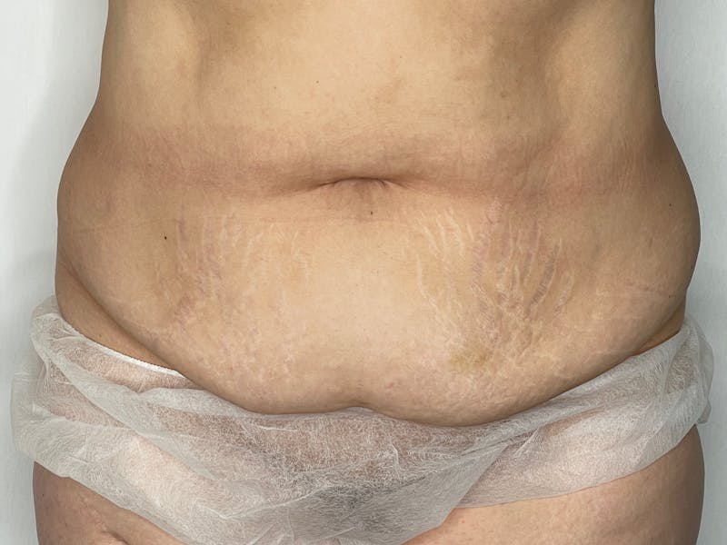 Tummy Tuck Before & After Gallery - Patient 101442998 - Image 1