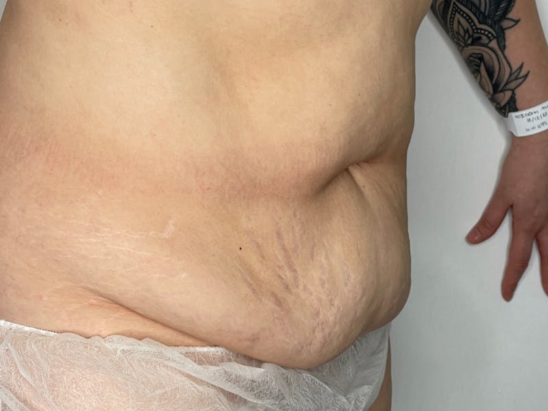 Tummy Tuck Before & After Gallery - Patient 101442998 - Image 3