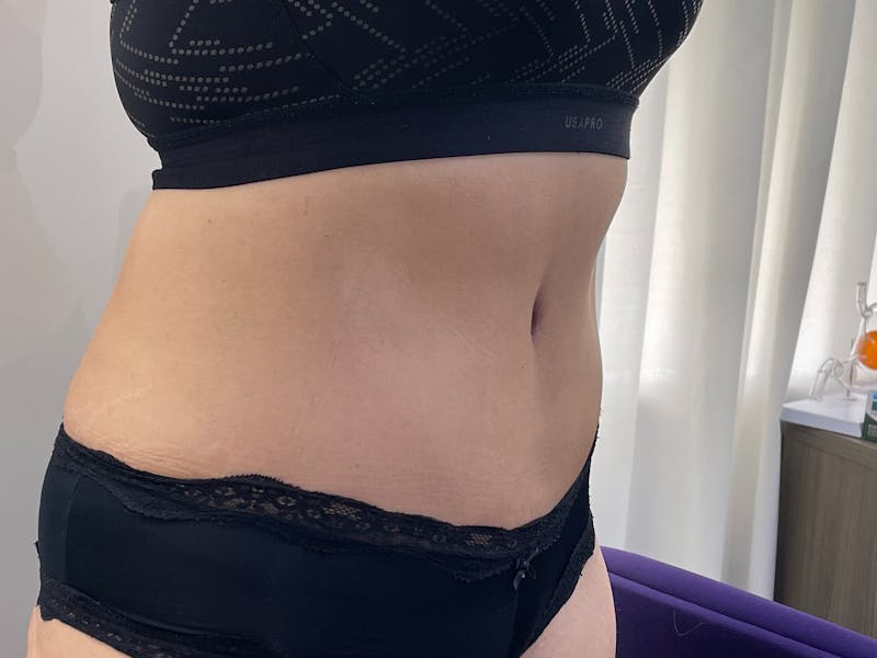Tummy Tuck Before & After Gallery - Patient 101442998 - Image 4