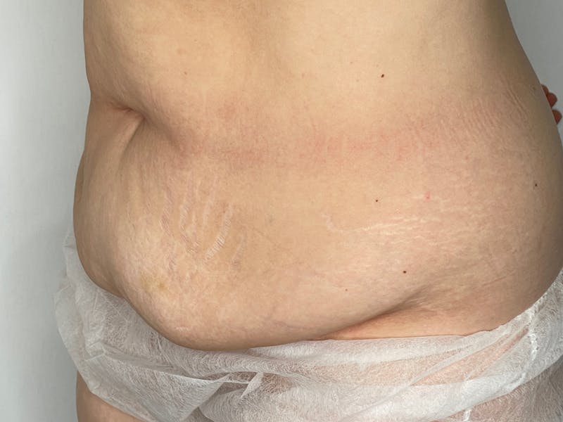 Tummy Tuck Before & After Gallery - Patient 101442998 - Image 5