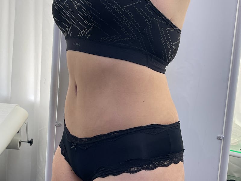 Tummy Tuck Before & After Gallery - Patient 101442998 - Image 6