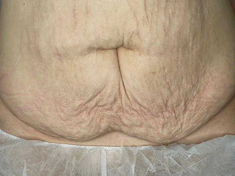 Tummy Tuck Before & After Gallery - Patient 101443302 - Image 1