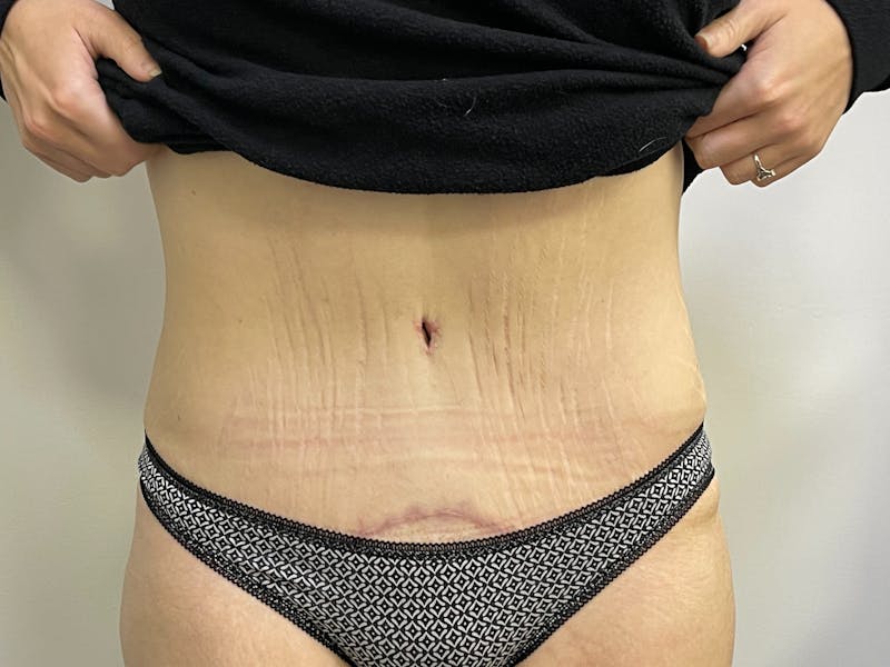 Tummy Tuck Before & After Gallery - Patient 101443302 - Image 2