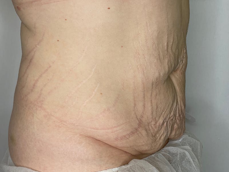 Tummy Tuck Before & After Gallery - Patient 101443302 - Image 3
