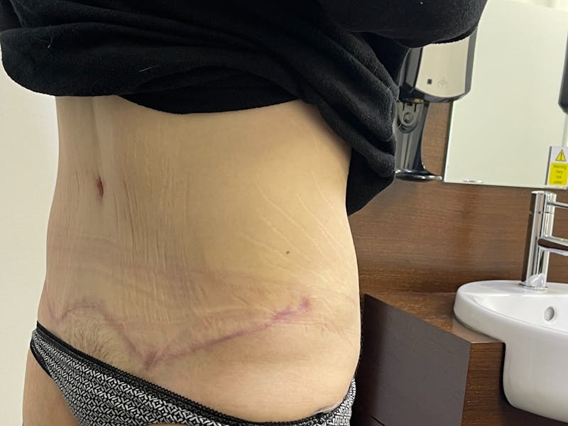 Tummy Tuck Before & After Gallery - Patient 101443302 - Image 4