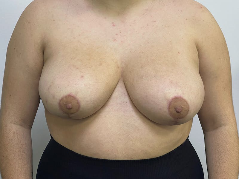Breast Reduction  Before & After Gallery - Patient 106999198 - Image 2