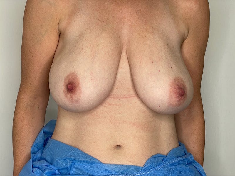 Breast Reduction  Before & After Gallery - Patient 106999201 - Image 1