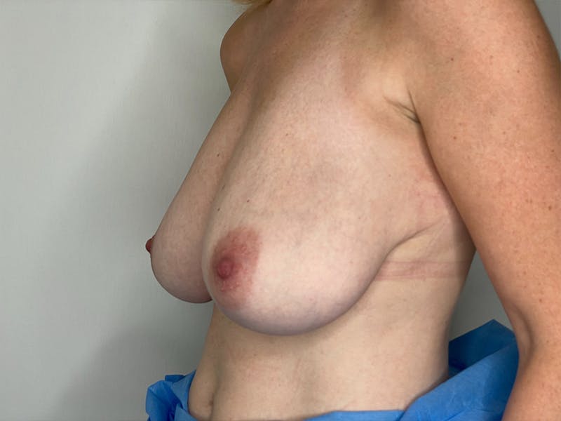 Breast Reduction  Before & After Gallery - Patient 106999201 - Image 3