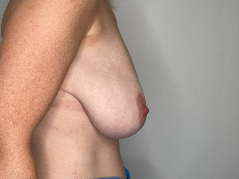 Breast Reduction  Before & After Gallery - Patient 106999201 - Image 5