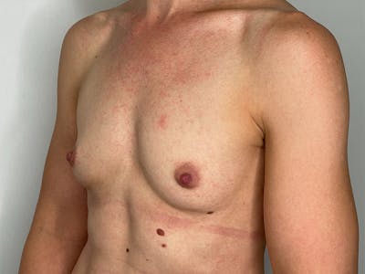 Breast Augmentation Before & After Gallery - Patient 106999862 - Image 1