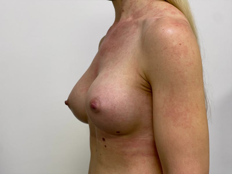Breast Augmentation Before & After Gallery - Patient 106999862 - Image 2