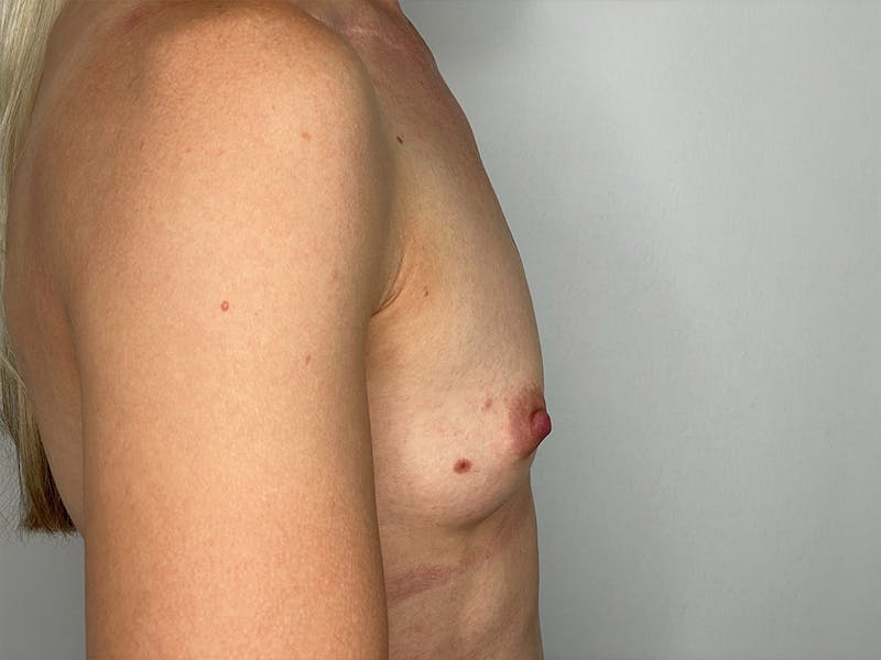 Breast Augmentation Before & After Gallery - Patient 106999862 - Image 3